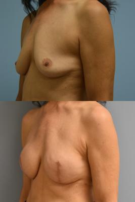 Breast Reconstruction