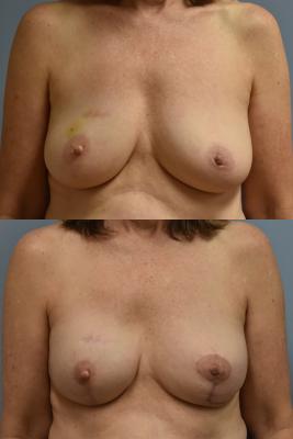 Breast Reconstruction