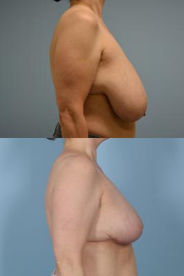 Breast Reduction