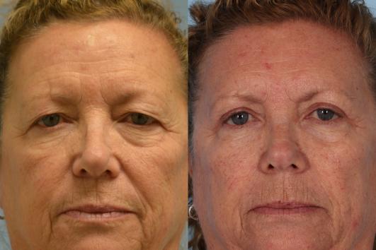 Upper Blepharoplasty