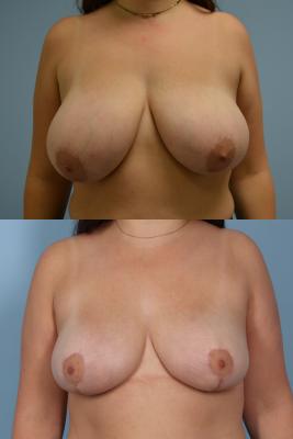 Breast Reduction