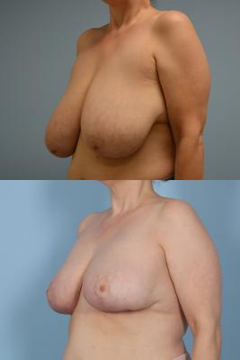 Breast Reduction