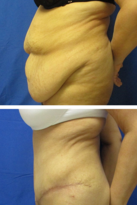 abdominoplasty before & after