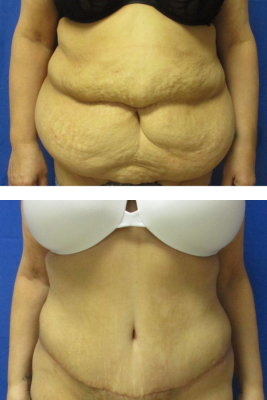 abdominoplasty before & after