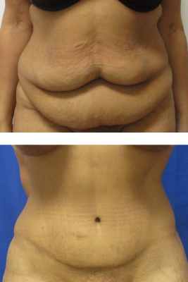 abdominoplasty before & after