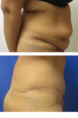 abdominoplasty before & after