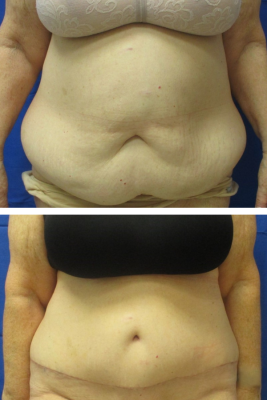 abdominoplasty before & after