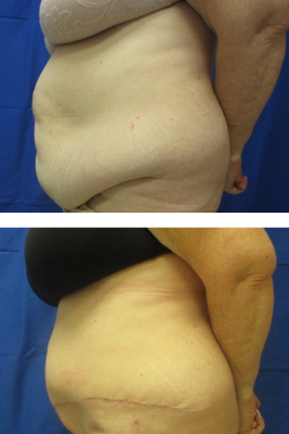 abdominoplasty before & after