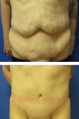 abdominoplasty before & after