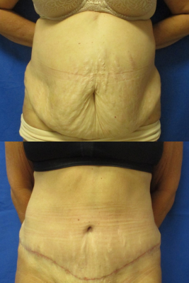 abdominoplasty before & after