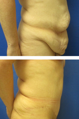 abdominoplasty before & after