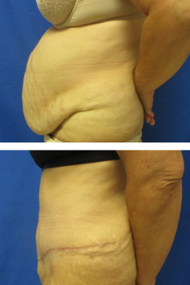 abdominoplasty before & after