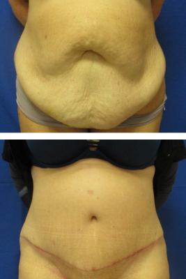 abdominoplasty before & after