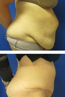 abdominoplasty before & after