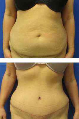 abdominoplasty before & after
