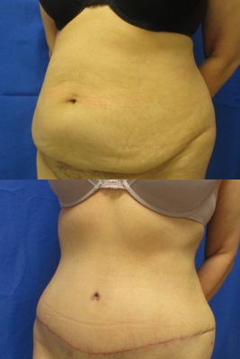 abdominoplasty before & after