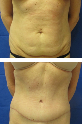 abdominoplasty before & after