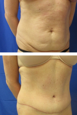 abdominoplasty before & after