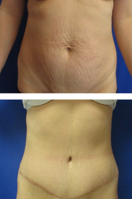 abdominoplasty before & after