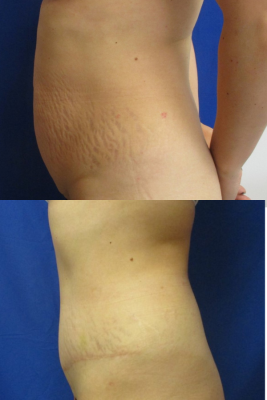 abdominoplasty before & after