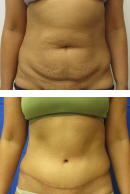 abdominoplasty before & after