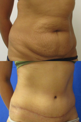 abdominoplasty before & after