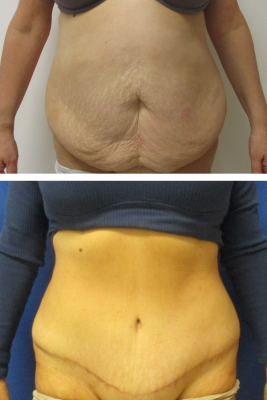abdominoplasty before & after