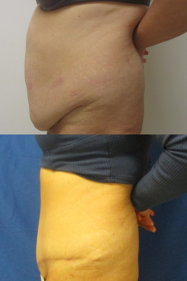 abdominoplasty before & after