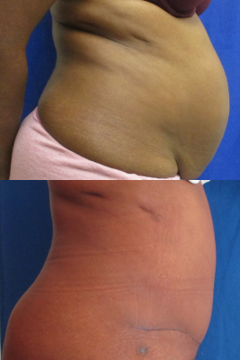 abdominoplasty before & after
