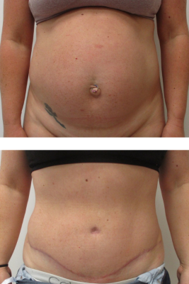 abdominoplasty before & after