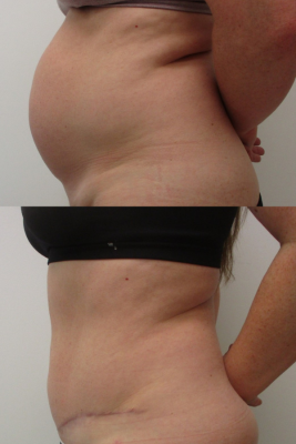 abdominoplasty before & after
