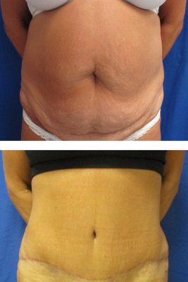 abdominoplasty before & after