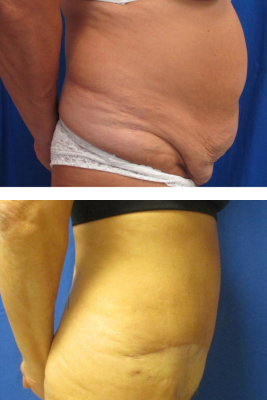 abdominoplasty before & after