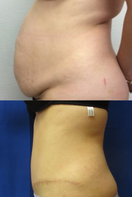 abdominoplasty before & after