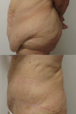 abdominoplasty before & after