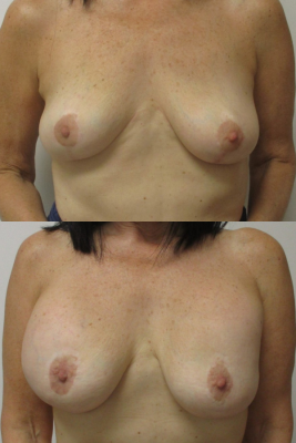Implant removal & breast lift before and after