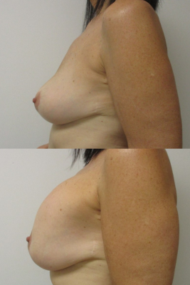 Implant removal & breast lift before and after