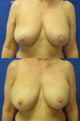 Implant removal & breast lift before and after