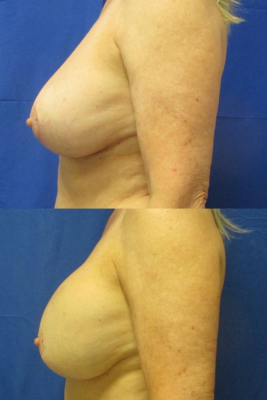 Implant removal & breast lift before and after