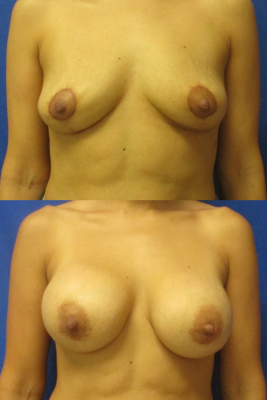 Implant removal & breast lift before and after