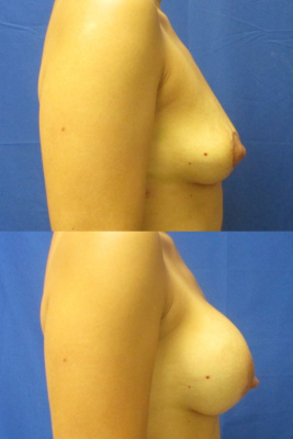 Implant removal & breast lift before and after