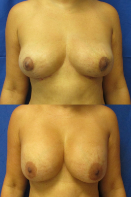 Implant removal & breast lift before and after