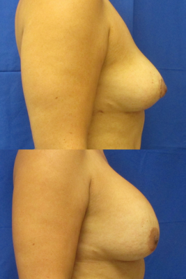 Implant removal & breast lift before and after