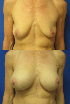 Breast augmentation before & after