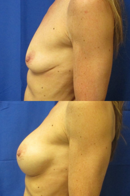 Breast augmentation before & after