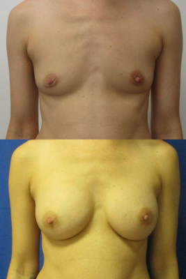 Breast augmentation before & after