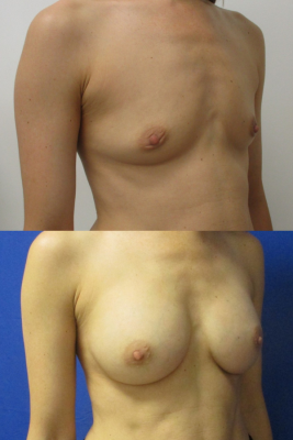 Breast augmentation before & after