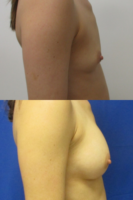 Breast augmentation before & after