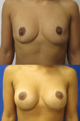 Breast augmentation before & after