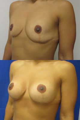 Breast augmentation before & after
